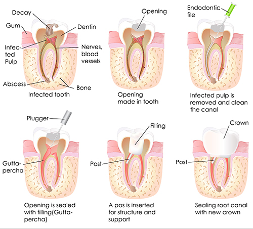 Fishers Root Canal Therapy