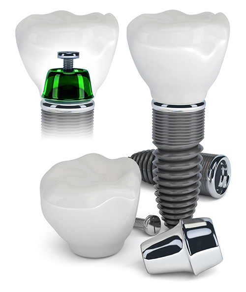 Fishers Dental Implants