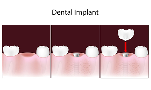 Implant Dentist in Fishers