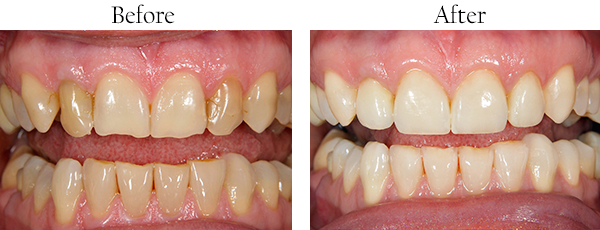 Fishers Before and After Dental Implants