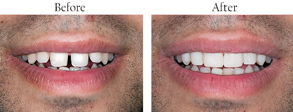 46037 Before and After Dental Crowns