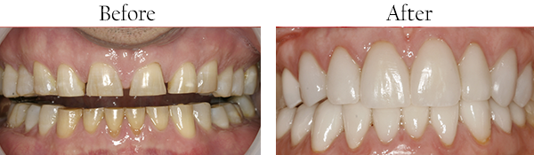 Fishers Before and After Teeth Whitening