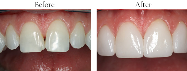 Fishers Before and After Dental Implants