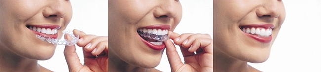 Fishers Invisalign